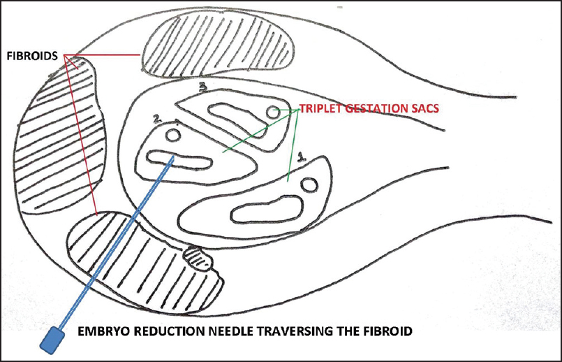 Line diagram of the ultrasound picture showing embryo reduction through the fibroid