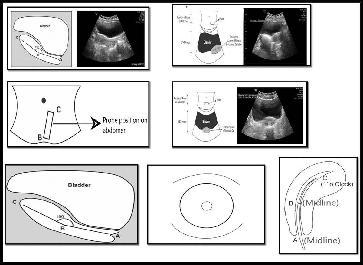 Pictorial representation of stepwise assessment of trajectory. Step 1: Sagittal plane of uterus. Step 2: Transverse section at point C(fundus) to see its relationship with bladder (Fundus is left side directed in the given picture). Step 3: Probe position on abdomen when sagittal image of uterus is focused, upper edge of probe corresponds to the direction of fundus (point C). Step 4: Transverse section at internal os (point B) and its relationship with bladder (Midline position of internal os in the given picture). Step 5: Sagittal image of cervix to look for cervical canal curvature. Step 6: Direction of External os (point A) on per speculum examination (Central position in the given picture). Step 7: Final trajectory (Point A-B-C)