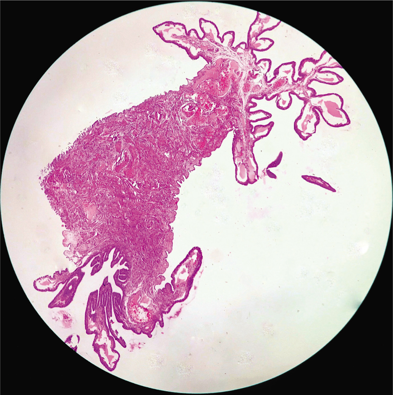 Histopathological section exhibiting an open fimbrial end and a stalk with typical tubal epithelial folds in the lumen (H and E, x100).