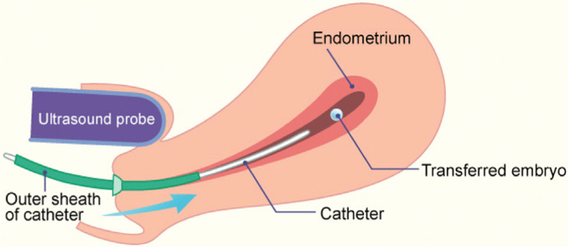 Embryo transfer technique