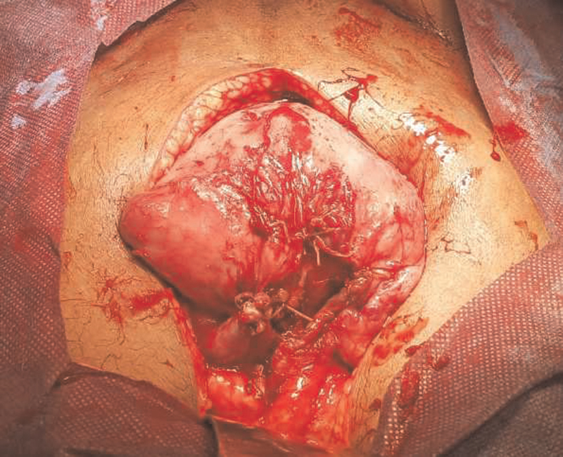 Superior aspect of uterus after cystectomy and partial salpingectomy.