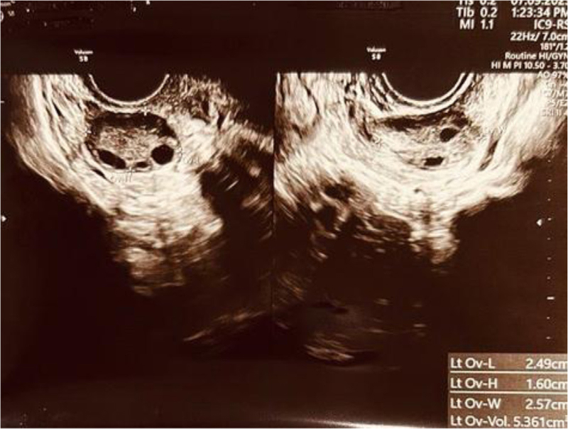 The USG (TVS) showing left and right ovary with antral follicle count (AFC) of 6-7.