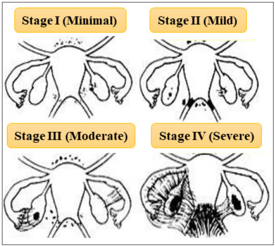 rASRM classification for endometriosis (This figure is modified from the https://www.endometriosis-india.com/classification-of-endometriosis/)