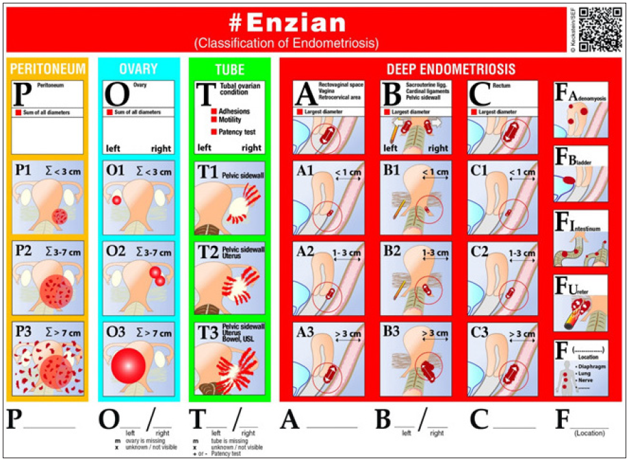 The ENZIAN stage system for endometriosis in women. Overview of the ENZIAN categorisation, including compartments and organs that may be impacted (doi: 10.1111/aogs.14099).