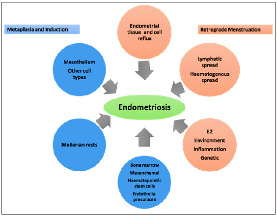 Theories regarding the pathophysiology of endometriosis (modified from https://doi.org/10.1016/j.fertnstert.2012.06.029).