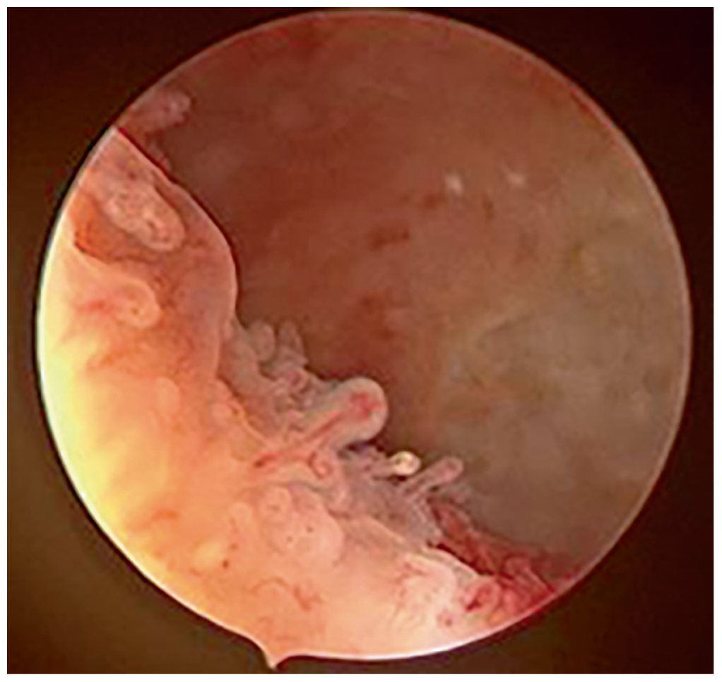 Micropolyps on the endometrium showing chronic endometritis.