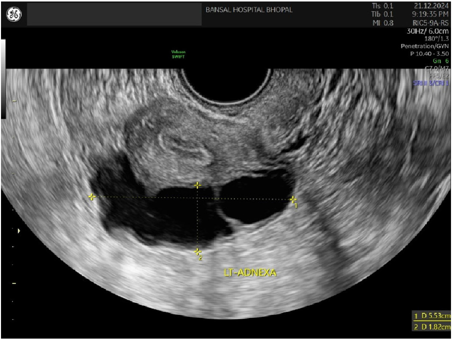 2D transvaginal scan showing a cystic mass behind the uterus