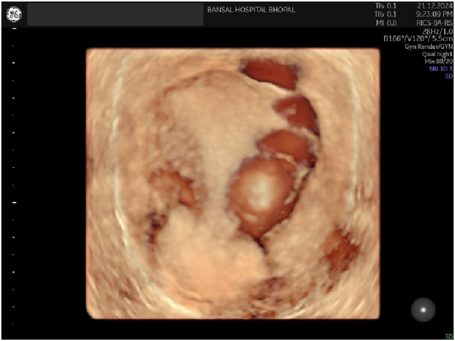 3D picture of the lesion