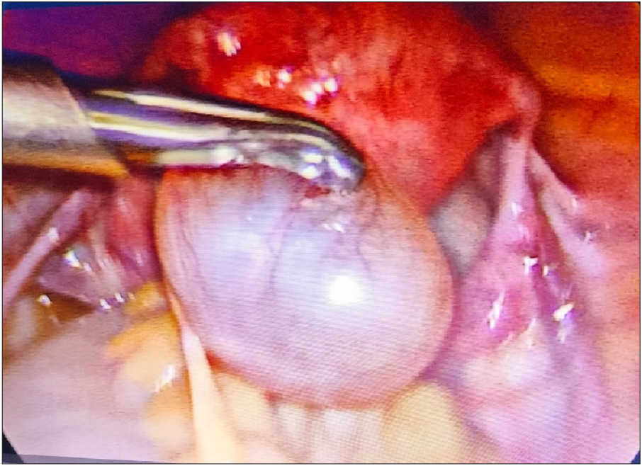 Intraoperative photograph showing a mesothelial cyst originating from the posterior wall of uterus