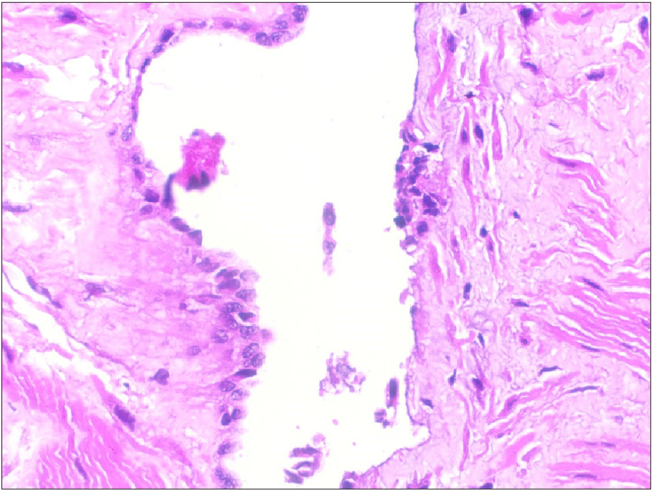 High-resolution microscopic findings confirming mesothelial cyst. Stain used: Haematoxylin and eosin (H&E) at a magnification of 400x