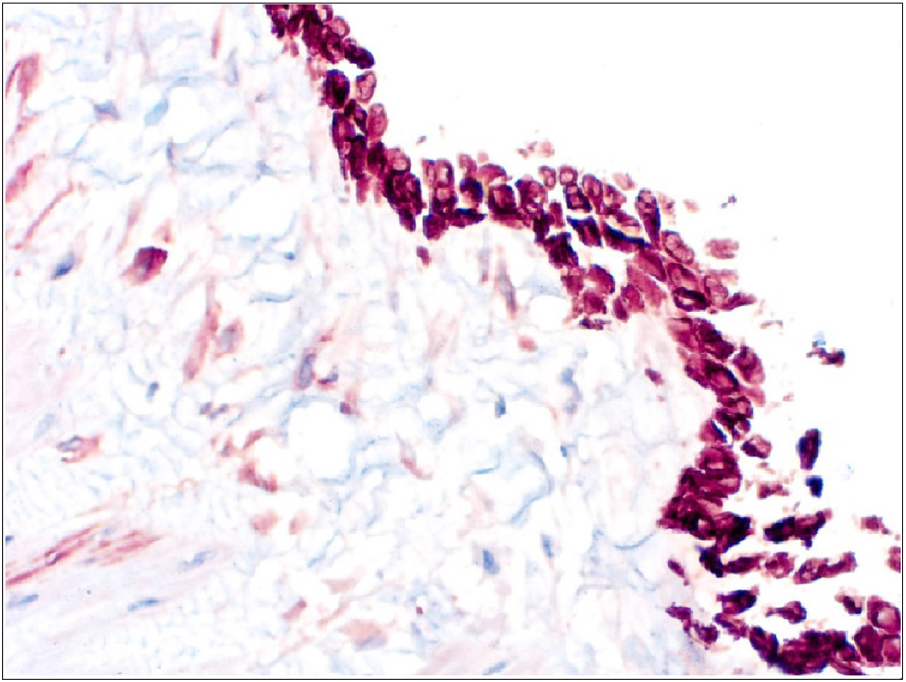 Immunohistochemistry test for CK5/6- positive. Stain used: Diaminobenzidine (DAB), at a magnification of 400X.