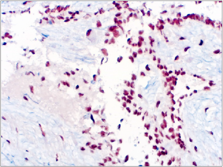 Immunohistochemistry test for WT1 - positive. Stain used: Diaminobenzidine (DAB), at a magnification of 400X